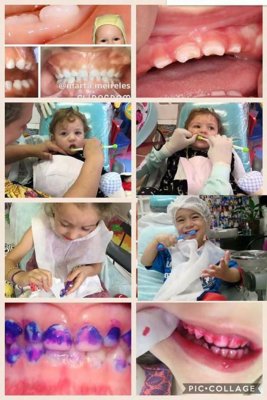 Importância do Flúor na prevenção da cárie dental